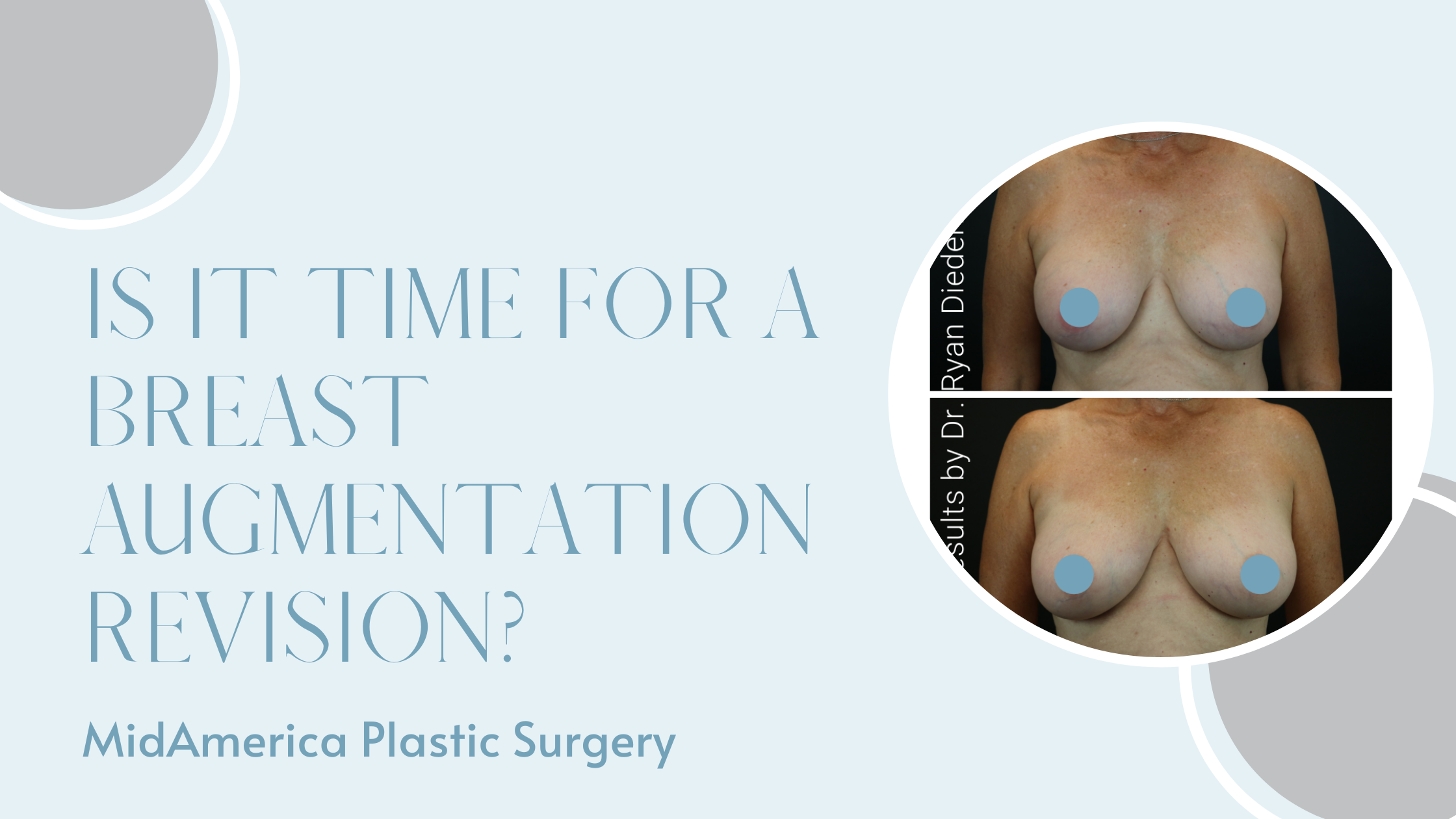 Is It Time for a Breast Augmentation Revision?