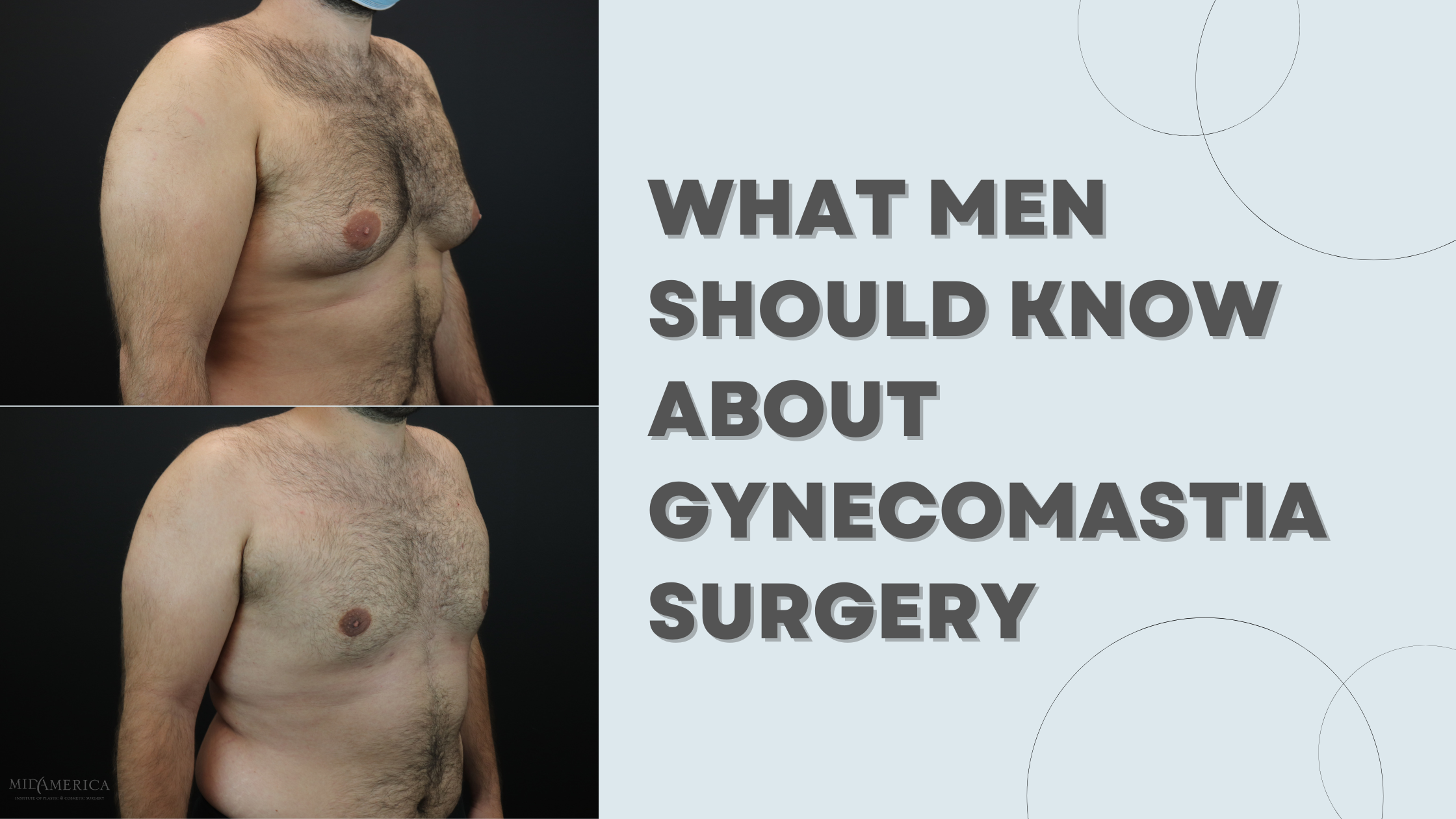 What Men Should Know About Gynecomastia Surgery
