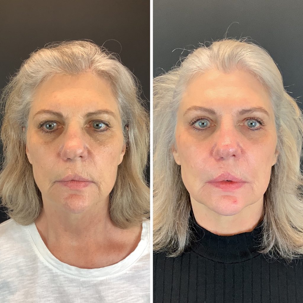 Sculptra Before and After Photo