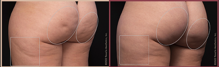 Aveli Cellulite Reduction Before & After