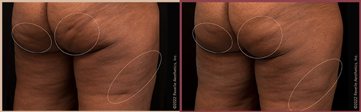 Aveli Cellulite Reduction Before & After